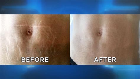 Can Surgery Remove Stretch Marks? Exploring the Possibilities and Beyond