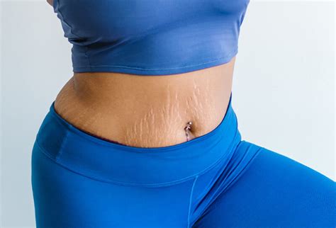 How to Cover Stretch Marks: Embracing Imperfections While Exploring Creative Solutions